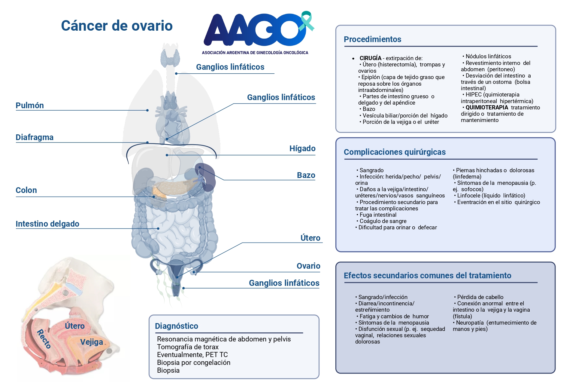 Cáncer de Ovario